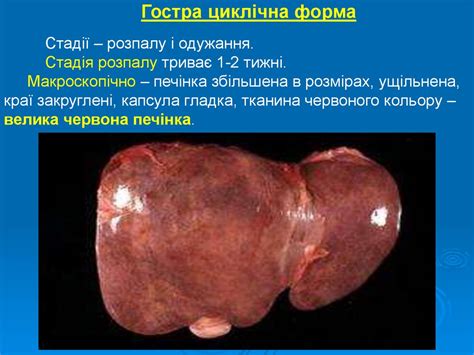 Хвороби печінки - презентация онлайн