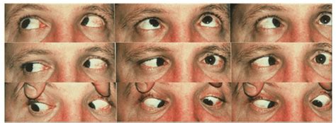 diplopia anesthesia key