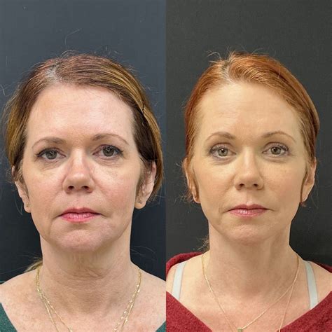 Eyelid Lift 11 - Austin, TX | Dr. Weinfeld