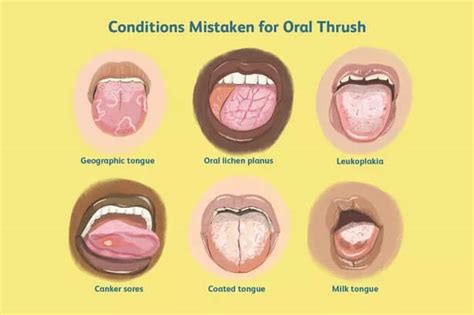 Tongue thrush | News | Dentagama