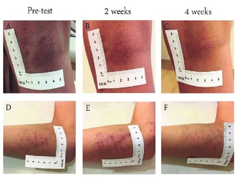 eczema    atopic dermatitis spread hollywood dermatology