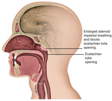 Adenoidectomy Edgecliff — ENT Surgeon East Sydney, Edgecliff | Dr Marco ...