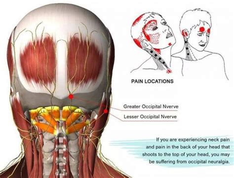 Occipital Neuralgia | FULL HEALTH SECRETS