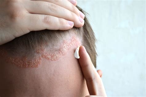 What is Seborrheic Dermatitis? - seborrheic dermatitis in scalp