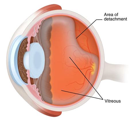 Posterior Vitreous Detachment Griffin | Takle Eye Group
