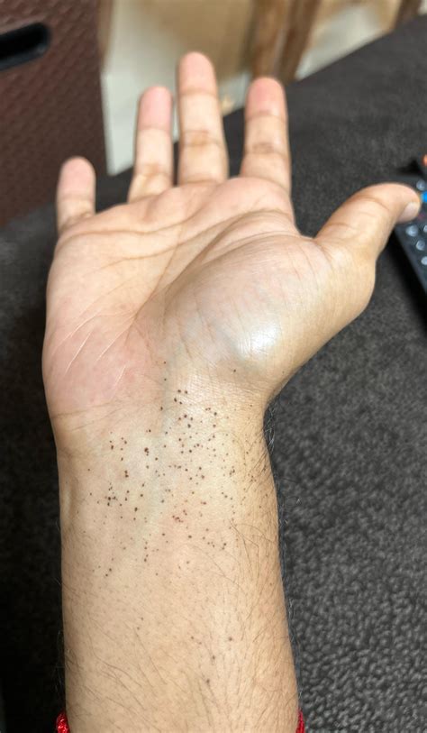 small black spots   wrist rdermatologyquestions