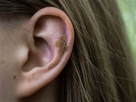 What Causes Scabs In My Ear? – Balmonds