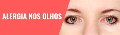 Alergia Ao Redor Dos Olhos O Que Pode Ser - Conjuntivite Alérgica - Alergia nos Olhos