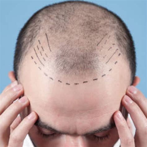 top hair restoration clinics  hinjewadi   htpsouthdowns