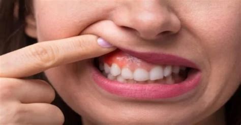 epulis pengertian gejala   mengobatinya