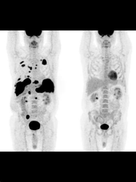 ПЭТ в оценке лечения — 24Radiology.ru