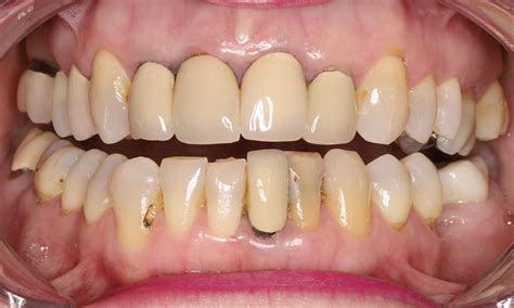 front crowns    humble tx