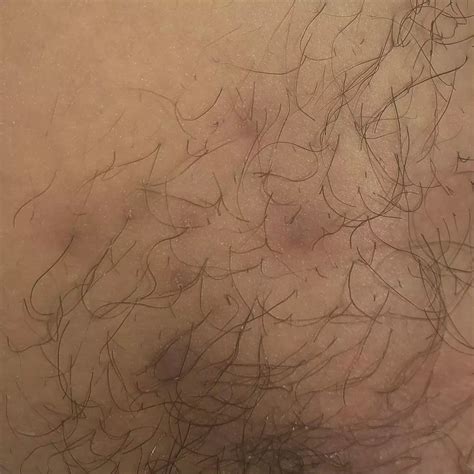 An explanation of why large popping cysts form on the skin 31