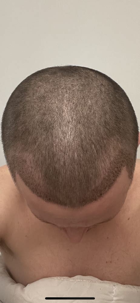 Uneven hairline after HT | Hair loss Forum - Hair Transplant forums