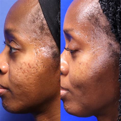 Acne scars before and after black skin - Social Social Social | Social ...