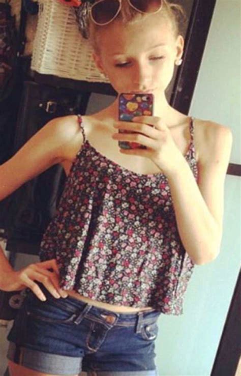 Anorexic Teen Who Lived On Nothing But Chewing Gum And Sparkling Water ...
