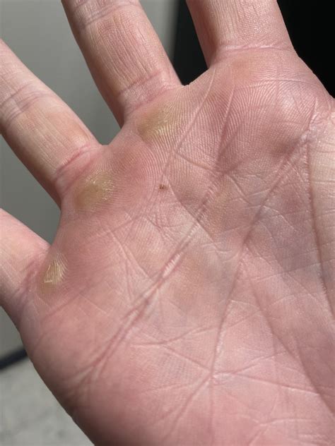 Small brown spot on palm : r/DermatologyQuestions