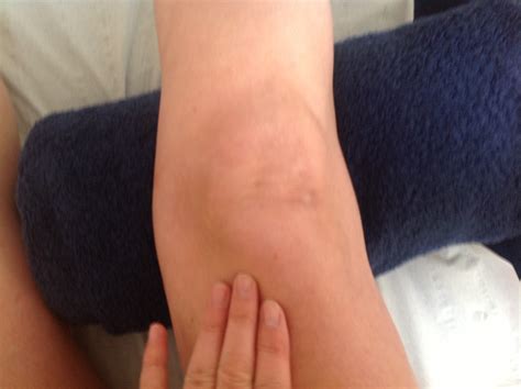 Cureus Apophysitis Of The Tibial Tuberosity (Osgood-Schlatter Disease