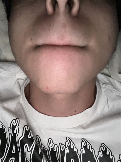How to fix uneven jaw bone? Plz help (16M) me left side is the skinner