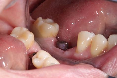 Циркониевая коронка на имплантанте - dentalhit
