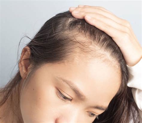 how to treat alopecia hair loss