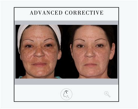 Facial Aesthetics Center | Chemical Peel Gallery