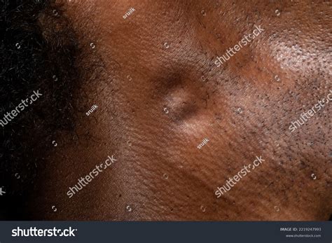 Macro Swollen Lymph Nodes Neck African Stock Photo 2219247993 ...