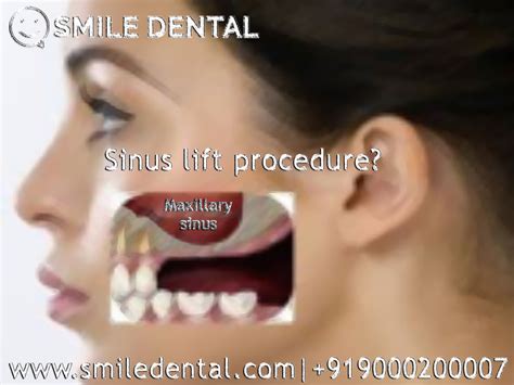 sinus lift procedure | Smile dental, Sinusitis, Dental implants