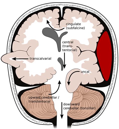 Types of brain herniation[3] 1) Uncal 2) Central 3) Cingulate or sub