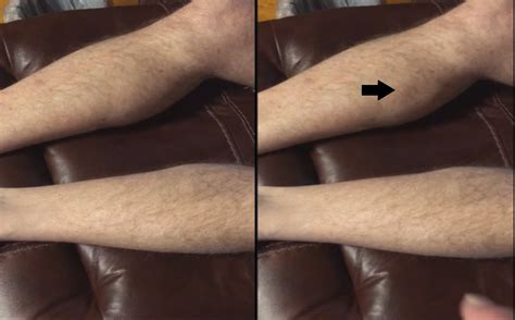 fasciculations   cholinesterase inhibitor mds abstracts