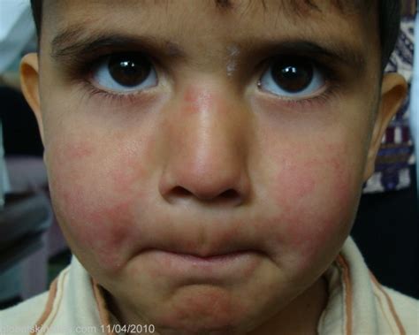 global skin atlas diagnosis detail