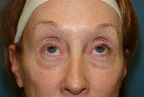 Eyelid Lift Archives | Schmidt Plastic Surgery