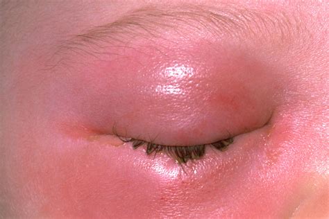 cellulitis symptoms treatment   healthdirect