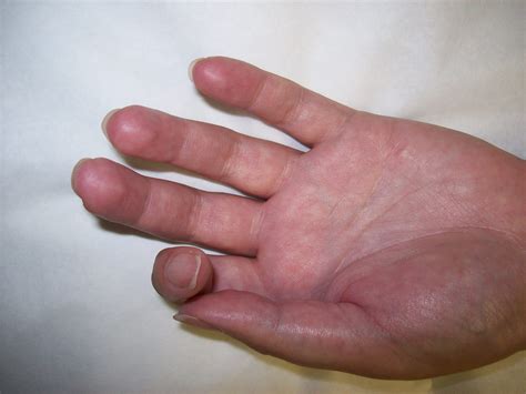 Reflex Sympathetic Dystrophy Rsd And Complex Regional Pain Syndrome