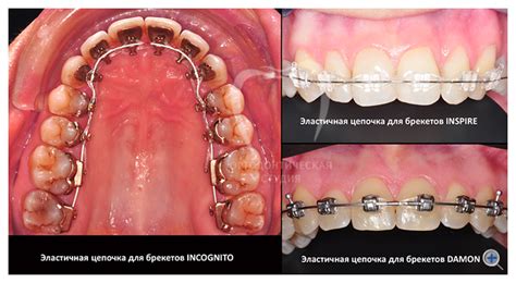 Элементы брекет-системы: ортодонтические кольца, дуга, лигатуры ...
