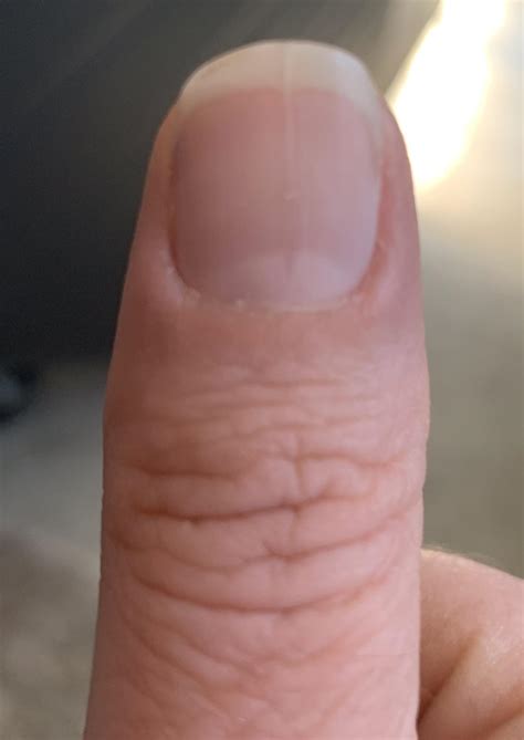 Why Is My Thumb Nail Rough at Ruben Lefebvre blog