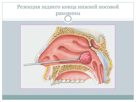 Острый и хронический ринит. (Лекция 4) - презентация онлайн