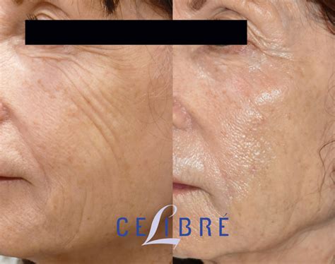 sculptra    real face body real results