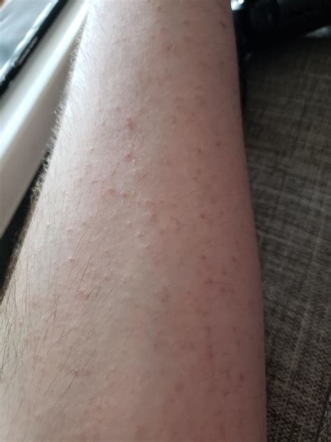 Small Itchy Bumps With Red Center at Sherlyn Weyer blog