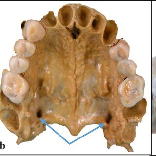 Inferior view of the bony palate. Greater palatine foramen (blue arrow ...
