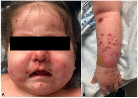 A pediatric case of human herpesvirus 6–associated pityriasis