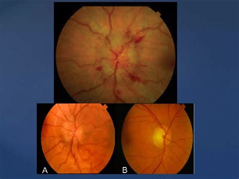 Dd sudden loss of vision prof munim | PDF