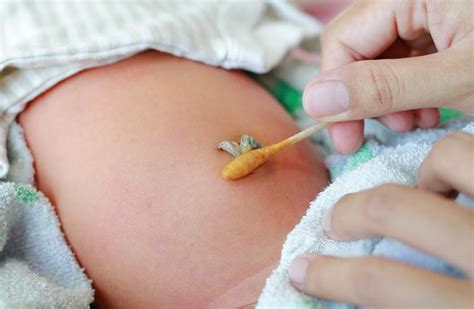 Fotos De Coto Umbilical Inflamado - Cordão umbilical infectado: sintomas e tratamento - Mães e filhos