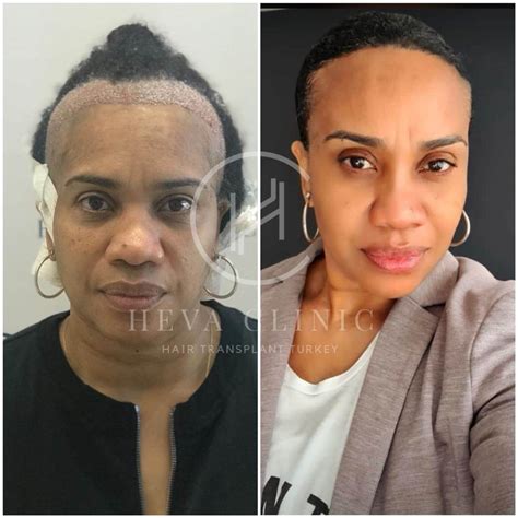 turkey hair transplant before and after 13