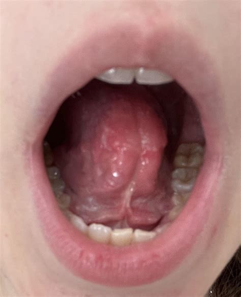 Tongue still short after tongue tie release : r/orthotropics