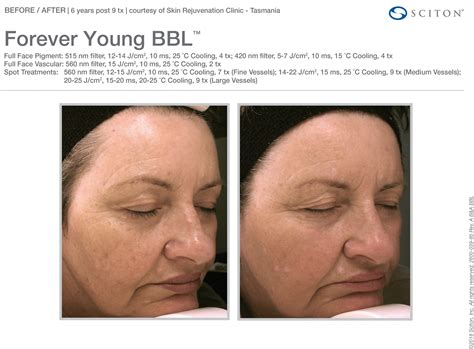 Forever Young BBL - Laser Spa Group