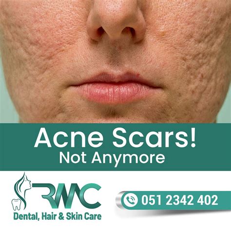 Acne Scars Removal Treatment In Islamabad - Rehman Medical