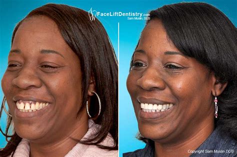 Buck Teeth Before And After