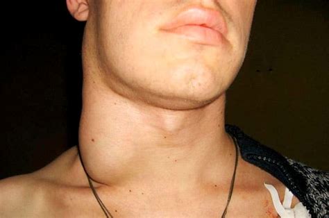 Рак лимфоузлов: причины, симптомы, методы лечения, прогноз