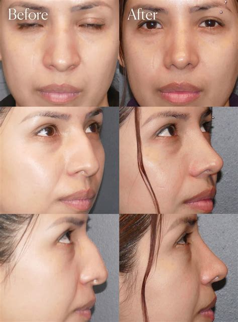 Rhinoplasty Photos | Denver, CO | Shah Aesthetic Surgery